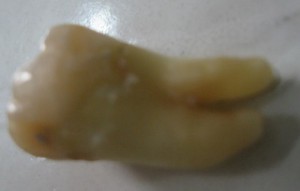 wisdom_tooth_1