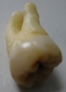 wisdom_tooth_2